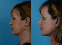 Woman treated with a SMAS Facelift, Necklift, Liposuction, Chin Implant and Chemical Peel