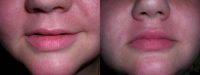 Female Treated with Cosmetic Filler