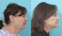 Woman treated with Deep Plane Facelift