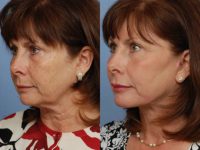 Facelift, Lip Augmentation and CO2 Laser Skin Rejuvenation