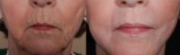 Hetters Peel around the mouth and Fat Injections
