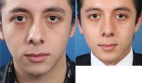Hispanic Male Septorhinoplasty and Chin Implant