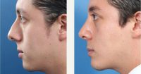 Hispanic Male Septorhinoplasty And Chin Implant Before With Dr. Aaron Kosins, MD, Newport Beach Plastic Surgeon