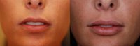 Juvederm in the Lips
