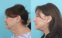 Woman treated with Deep Plane Facelift