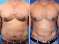 Male Liposuction and Gynecomastia