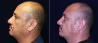 Male Rhinoplasty Before With Dr John Squires, MD, Denver Plastic Surgeon 962