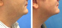 Male Treated for Chin Liposuction