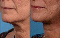 Woman treated with a Facial Rejuvenation SMAS Facelift, Necklift, and Liposuction