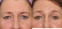 Woman treated with Endoscopic Brow Lift / Forehead Lift