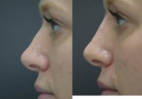 Non-Surgical Rhinoplasty for Hump Reduction
