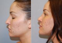 Nose Reshaping Before By Dr. Richard Chaffoo, MD, FACS, San Diego Plastic Surgeon