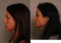 Open Septo-Rhinoplasty W Tip Plasty  Tip Graft Before By Dr Christian G. Drehsen, MD, Tampa Plastic Surgeon