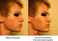 Plastic Surgery Of Nose With Dr Andrew B. Denton, MD, Vancouver Certified Facial Plastic Surgeon