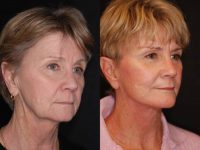 QuickLift Plus Submental Tuck, Chin Implant, & TCA Peel 35% on full face