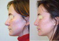 Revision Rhinoplasty Before By Doctor Stella Desyatnikova, MD, Seattle Facial Plastic Surgeon