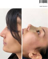 Revision Rhinoplasty By Doctor Lucian Ion, FRCS, London Specialist Registered Plastic Surgeon