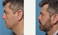 Rhinoplasty And Chin Implant With Neck Liposuction Before With Dr. Kian Karimi, MD, FACS, Los Angeles Facial Plastic Surgeon