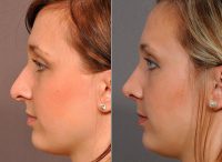 Rhinoplasty Before By Dr Vito C. Quatela, MD, Rochester Facial Plastic Surgeon