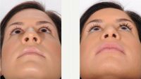 Rhinoplasty Before By Dr William H. Sabbagh, MD, Detroit Plastic Surgeon