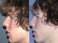 Rhinoplasty Before By Dr. Larry S. Nichter, MD, MS, FACS, Orange County Plastic Surgeon