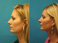 Rhinoplasty Before By Dr. Lee Robinson, MD - RETIRED, Portland Facial Plastic Surgeon