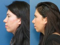 Rhinoplasty Before With Doctor Adam D. Stein, MD, Raleigh-Durham Facial Plastic Surgeon
