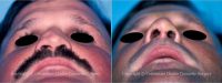 Rhinoplasty Before With Dr Thomas Trevisani, Sr., MD, Orlando Plastic Surgeon