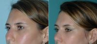 Rhinoplasty Before With Dr. Paul L. Leong, MD, FACS, Pittsburgh Facial Plastic Surgeon