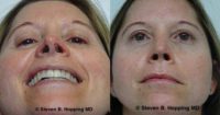 Straightening the nose can make a big difference.