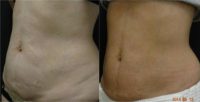 Thermage Skin Tightening - Stomach