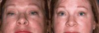 Upper Eyelid Blepharoplasty and Ptosis Repair
