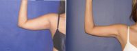 Vaser Liposuction of Arms