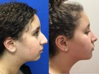 17 or under year old woman treated with Chin Surgery