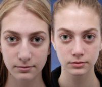 17 or under year old teenager treated with Rhinoplasty
