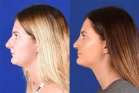 17 year old woman treated with Rhinoplasty