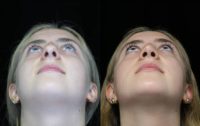 18-21 year old woman treated with Closed Scarless Rhinoplasty