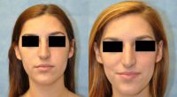 18 Year Old Female Treated for Unacceptable Cosmetic Appearance of Nose