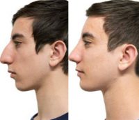 18 year old man treated with Chin Implant