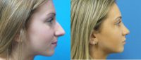 18 year old-Open Rhinoplasty w/submucous resection/Septoplasty & Spreader grafts to improve airway