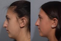 18-24-year-old woman treated with Septoplasty