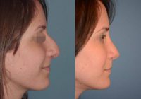 18-24 year old woman treated with Rhinoplasty & Sinus Surgery for a Deviated Septum