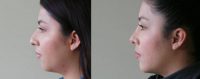 18-24 year old woman treated with Rhinoplasty and Chin Implant