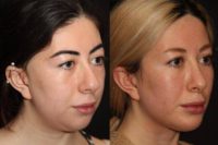 18-24 year old woman treated with Chin Surgery