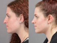 18-24 year old woman treated with SeptoRhinoplasty