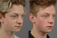 18-24 year old man treated with SeptoRhinoplasty