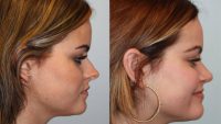 18-24 year old woman treated with Rhinoplasty for overprotected nasal tip