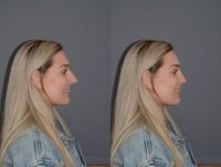20 year old woman treated with Rhinoplasty