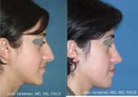 18-24 year old woman treated with Rhinoplasty and chin reduction