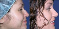 18-24 year old woman treated with Rhinoplasty